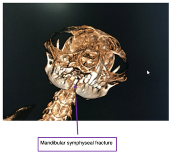 ct_can_mandibular_symphyseal_fracture